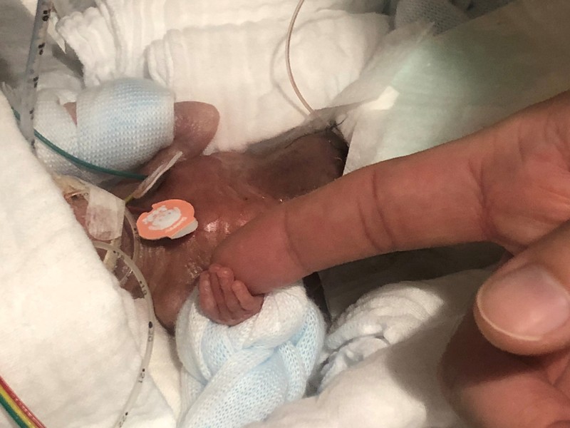 A baby boy weighing 268 grams when born in August 2018, the hospital claims is the smallest baby to survive and be sent home healthy, is seen five days after his birth in Tokyo